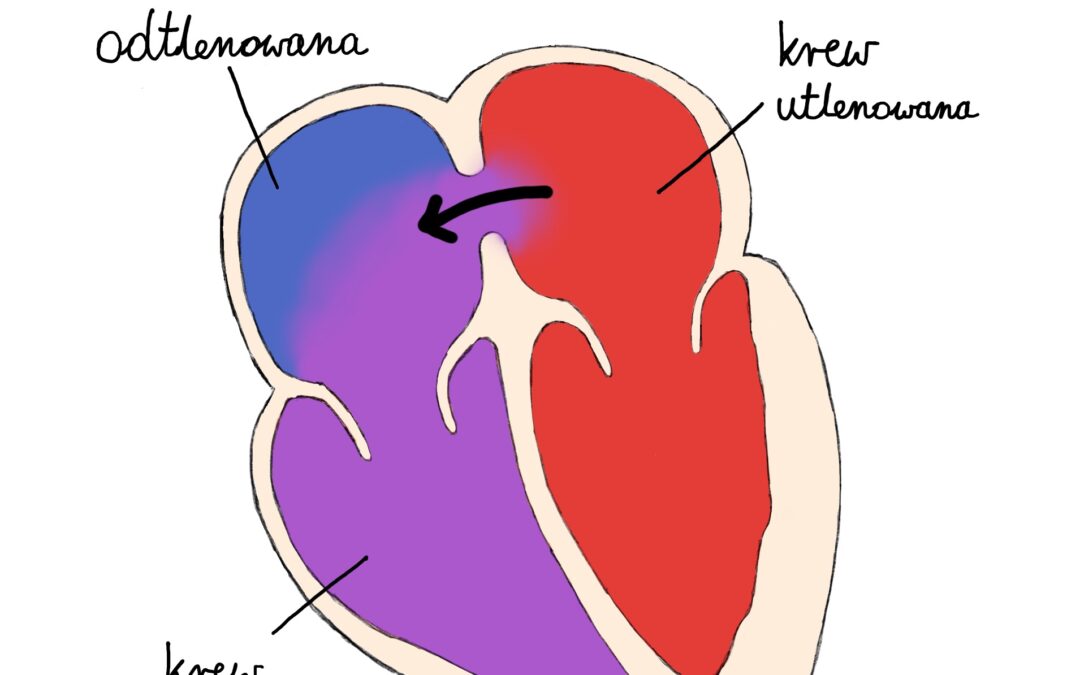 „Dziura” w sercu czyli ASD